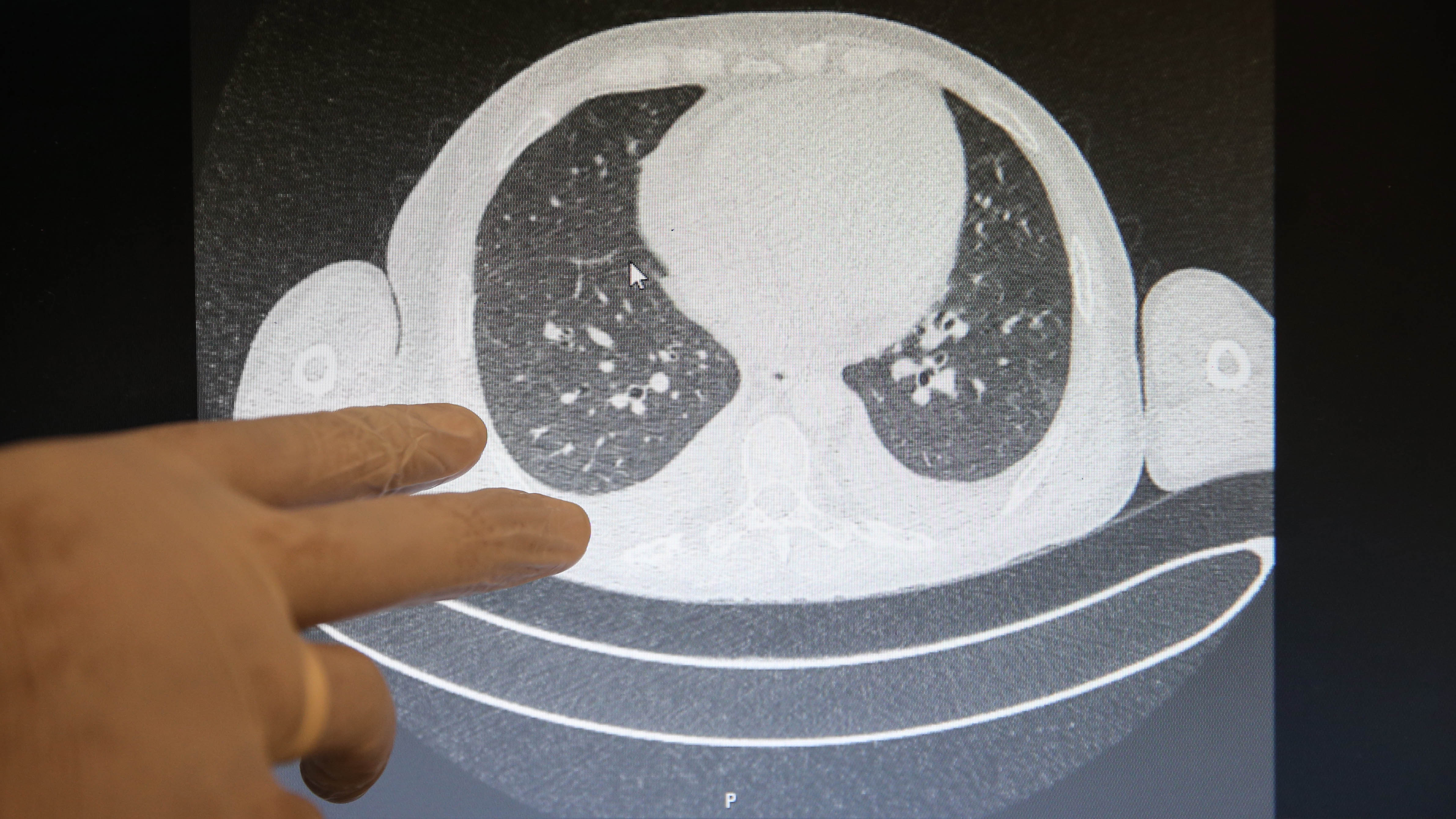 Koronavirüsün akciğerlere verdiği korkunç tahribat ortaya çıktı