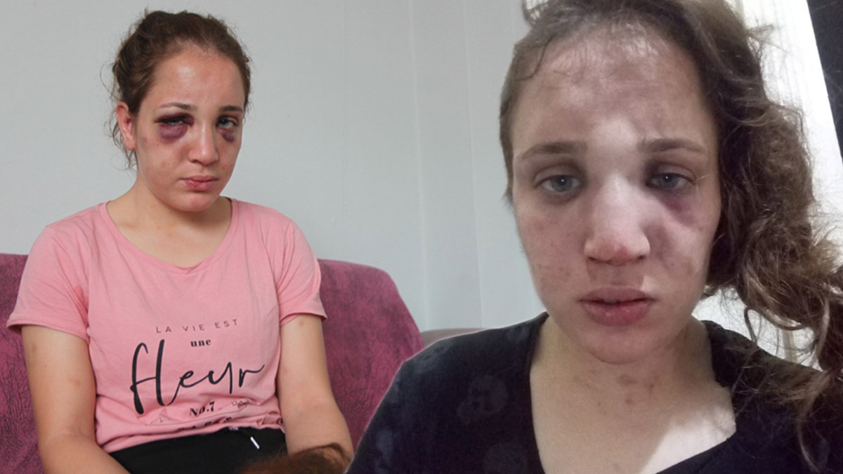 Eşi işkenceyle bu hale getirdi! Özlem'in yardım çığlığını duyun