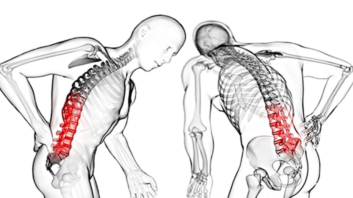 Ankilozan spondilit (As) hastalığı nedir?