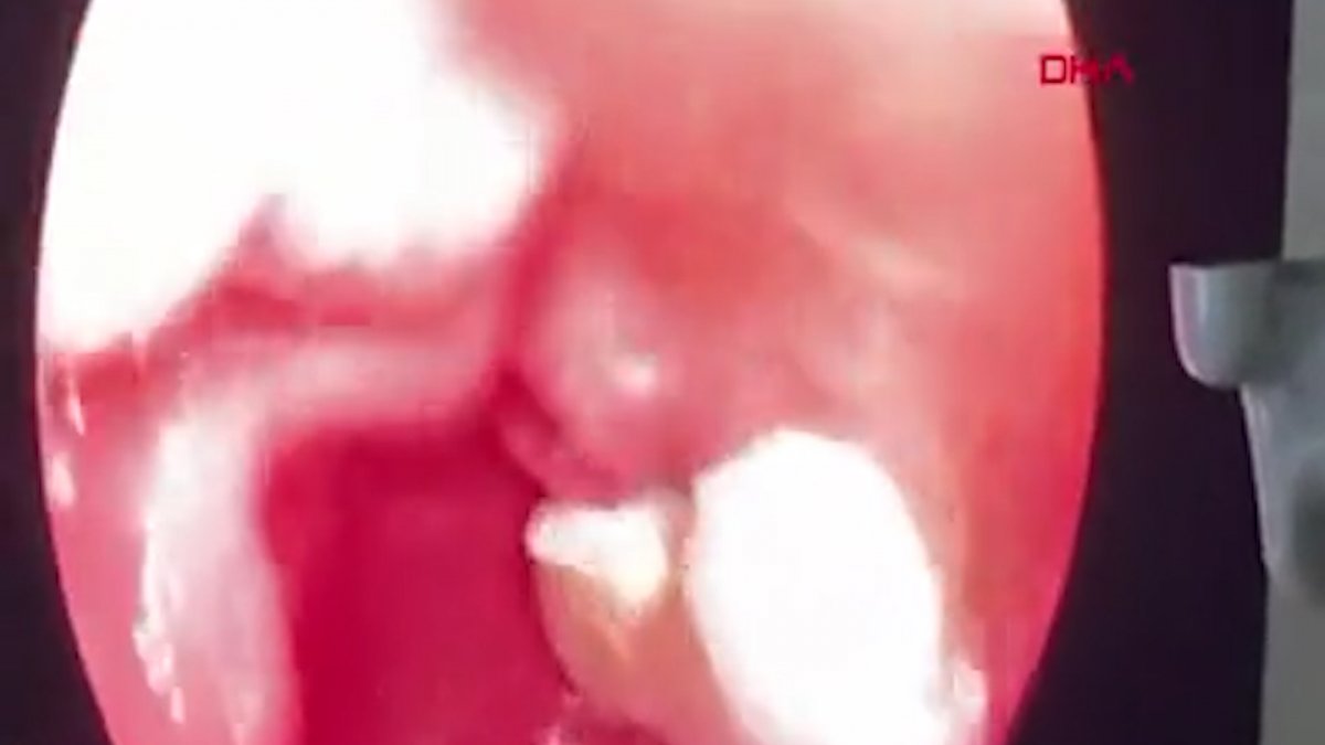 Uyuşturucu şüphelisinin yuttuğu eroin böyle çıkarıldı