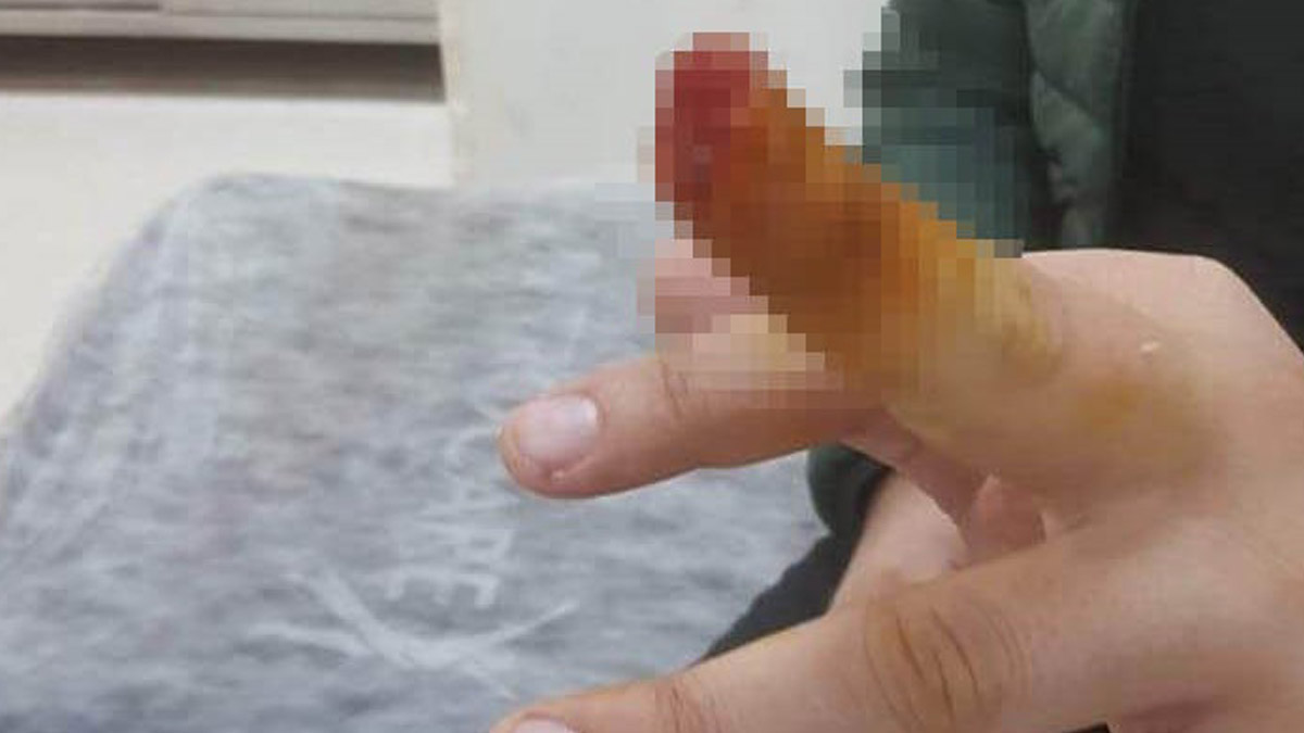 Hasta yakını güvenlik görevlisinin parmağını ısırarak kopardı