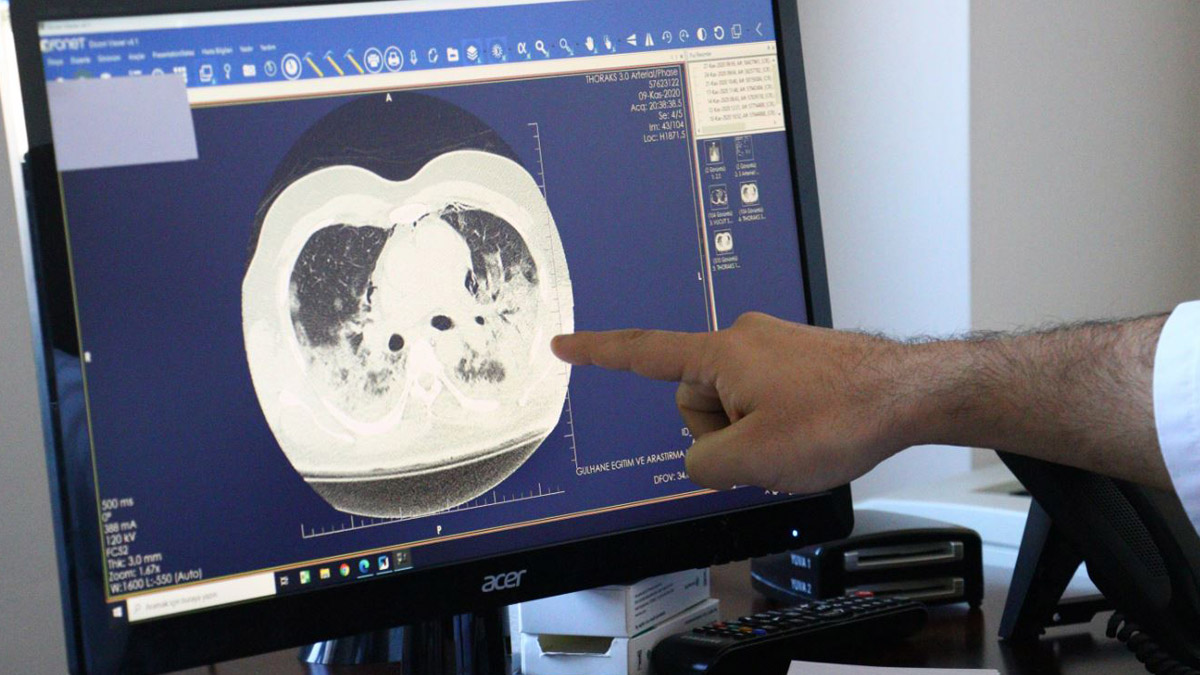 Koronavirüsün akciğerdeki hasarı tomografide