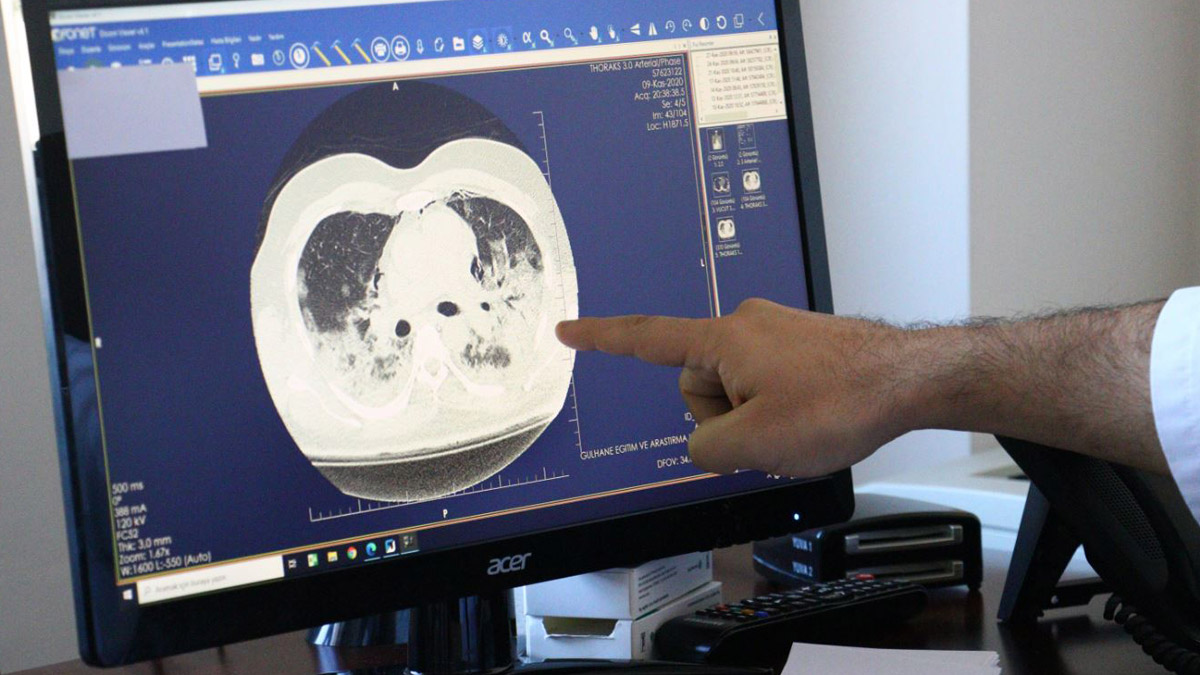 'Bu hastalar nasıl nefes alabiliyor?' İşte virüsün akciğere verdiği zarar