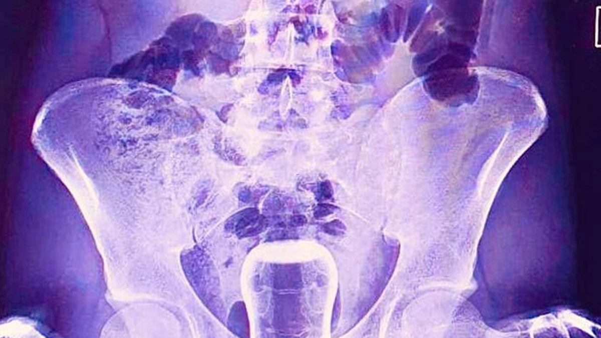 Şanlıurfa'da inanılmaz olay! Basur hacamatı hastanede bitti