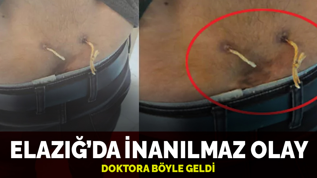 Elazığ'da inanılmaz olay: Doktoru şoke eden çamaşır ipli tedavi