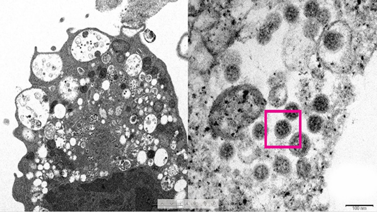 Dünya Sağlık Örgütü Omicron'un Delta'dan daha hafif semptomlar gösterdiğini açıkladı