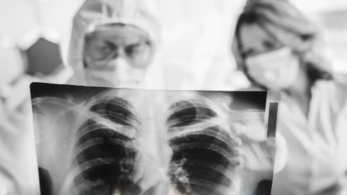 Kovid gitse de akciğerde izi kalıyor
