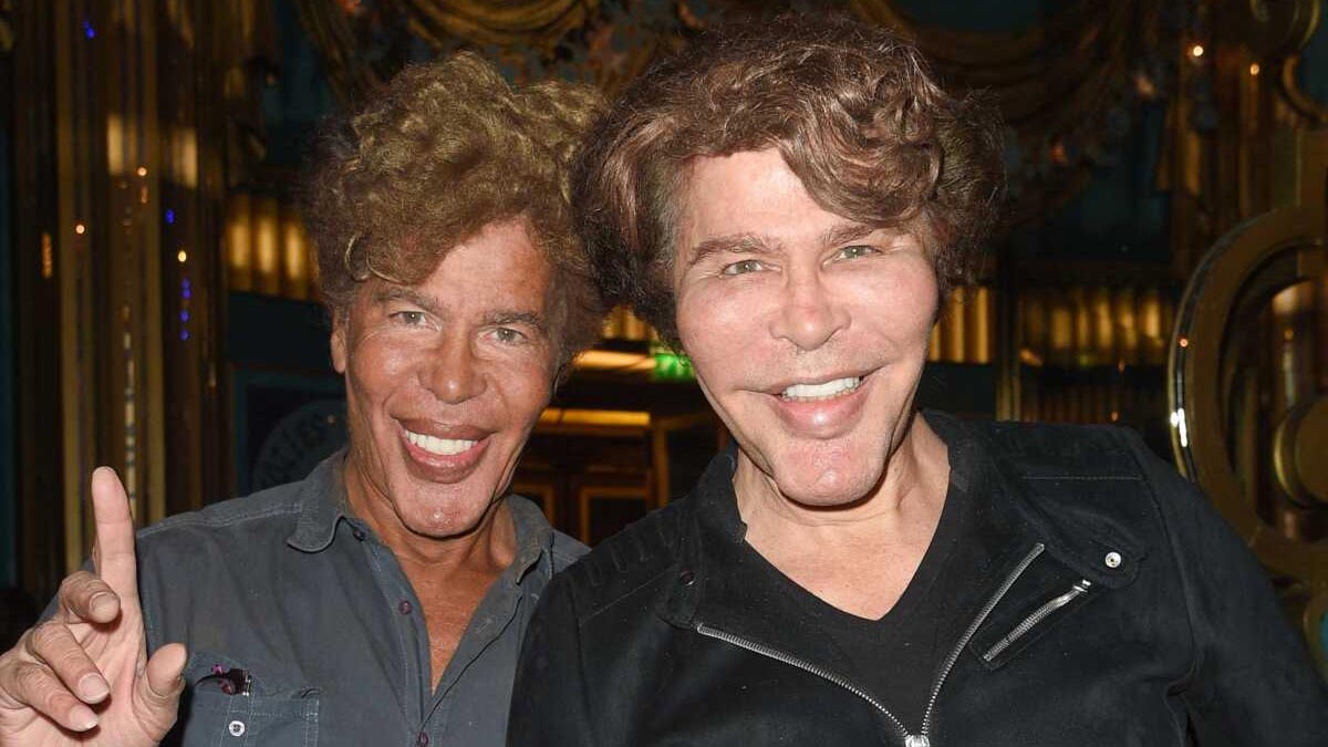 Bogdanoff Twins Acromegaly