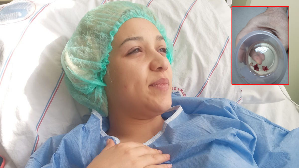 Adana'da inanılmaz olay: Baş ağrısı şikayetiyle hastaneye gitti burnundan taş çıktı