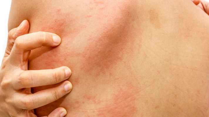 Doç. Dr. Demir'den kurdeşen uyarısı