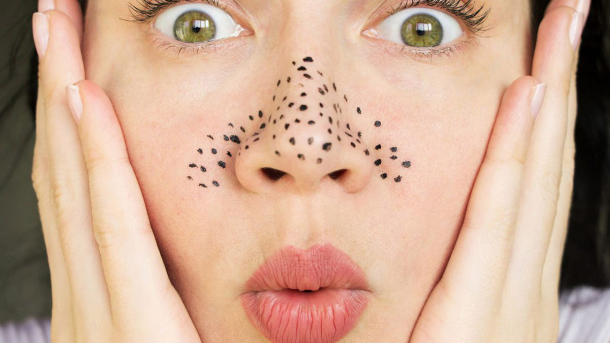 Yüzünüzdeki Siyah Noktaları Kolaylıkla Yok Edin! Bu Yöntemler Sayesinde Siyah Noktanız Kalmayacak