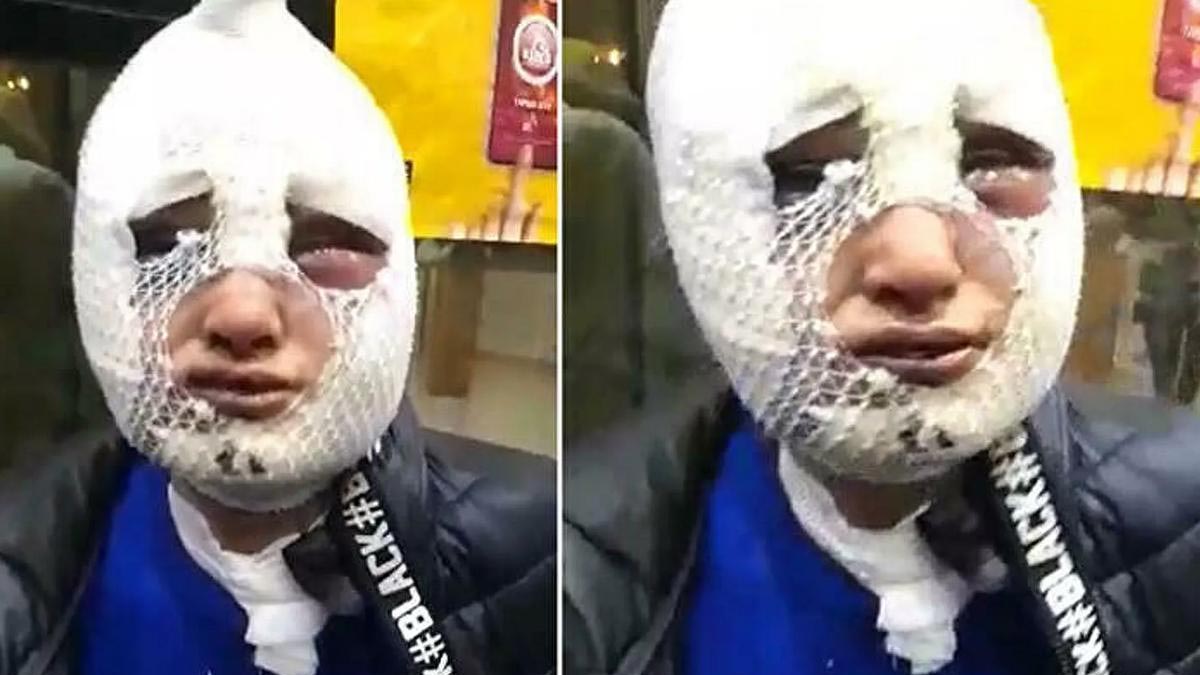 Kız arkadaşının yüzüne kızgın yağ döken kişi tekrar tutuklandı