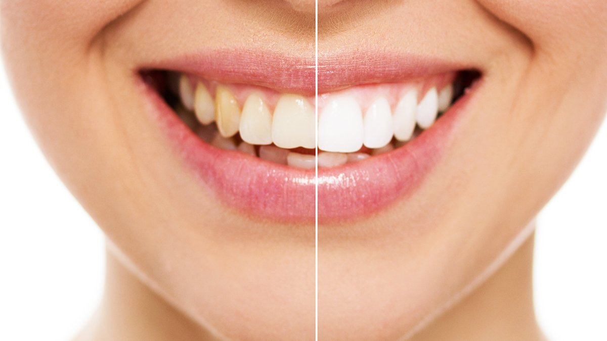 Diş Beyazlatma İçin Bakın En Güzel Çözüm Hangisi! Kısa Sürede Diş Beyazlasın Diyorsanız Bunları Deneyin