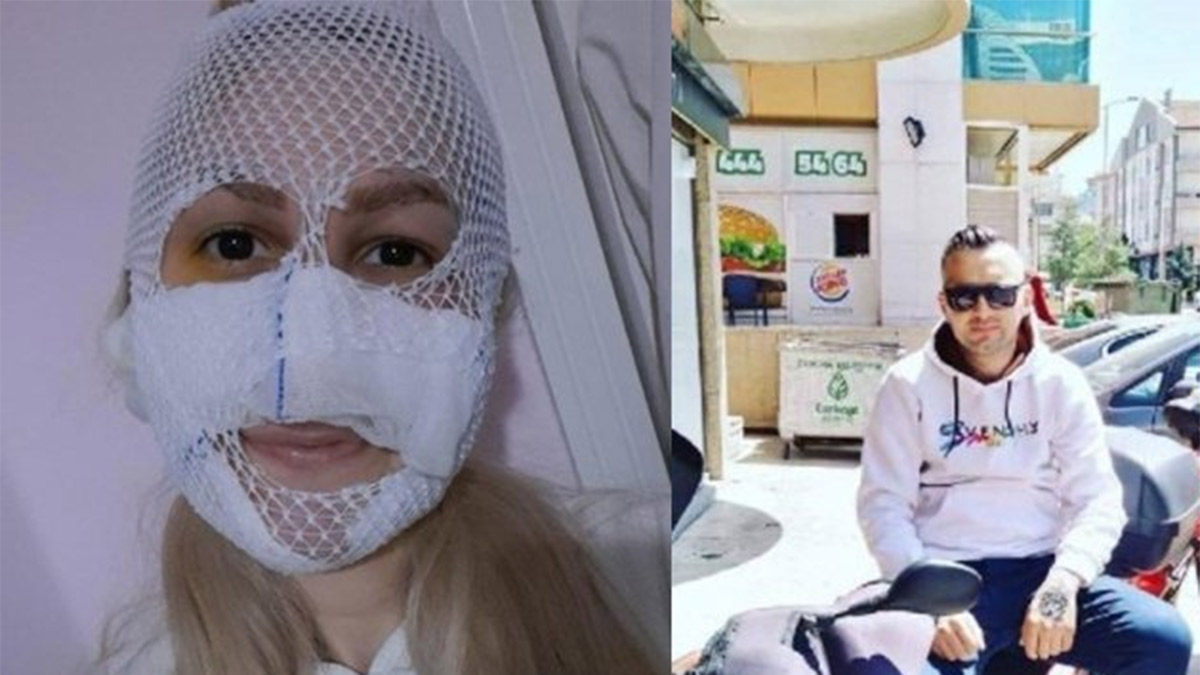 Kız arkadaşının yüzüne kimyasal madde atmıştı: Korkunç olayda yeni gelişme