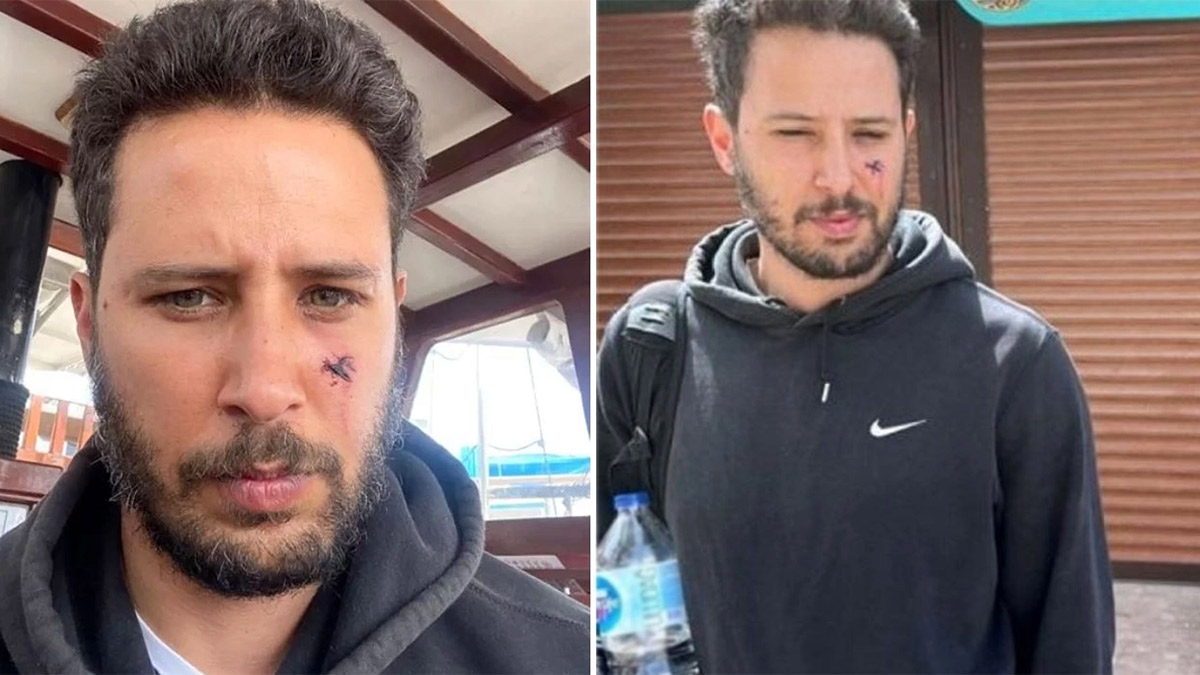 Oyuncu Tuan Tunalı'ya köpek saldırdı