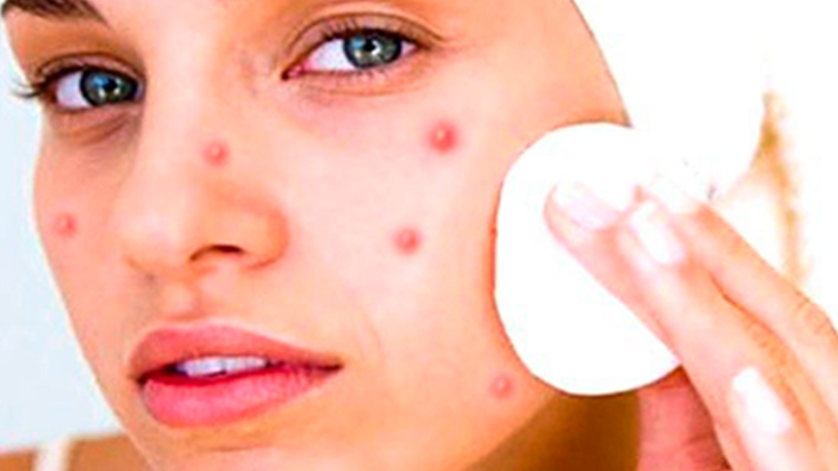 Sivilceler Ölümcül Hastalığın Kapısını Aralıyor!  Sivilcelerin Gerçek Nedenini Öğrenince Hastaneye Koşacaksınız