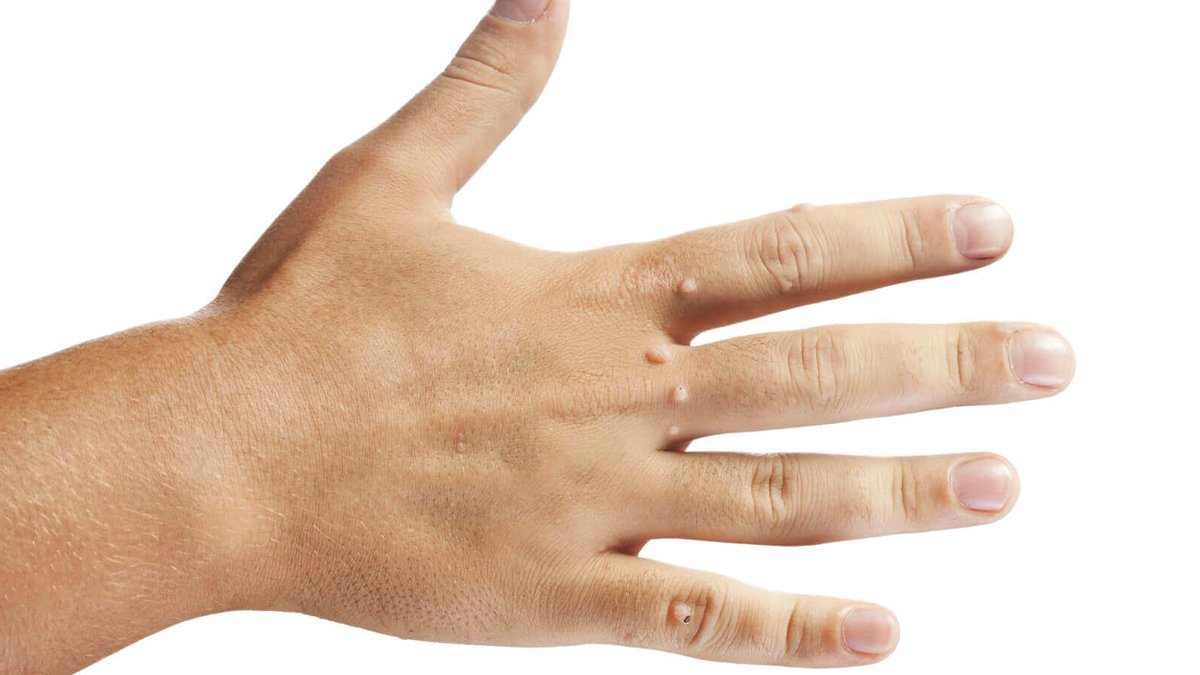 Ellerinizdeki Siğillerden Saniyesinde Kurtulun! İşte Tıbbın Babası İbn-i Sina'nın Siğil Geçirme Yöntemi