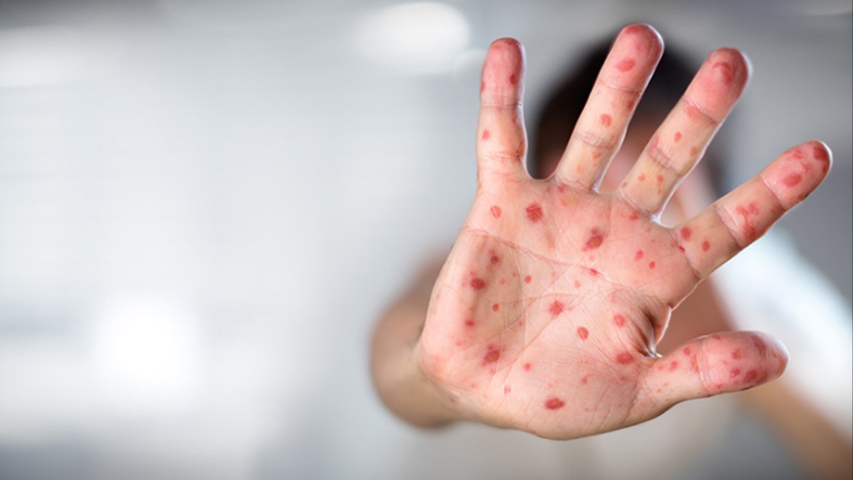 Maymun çiçeği virüsü alarmı: 12 ülkede görüldü