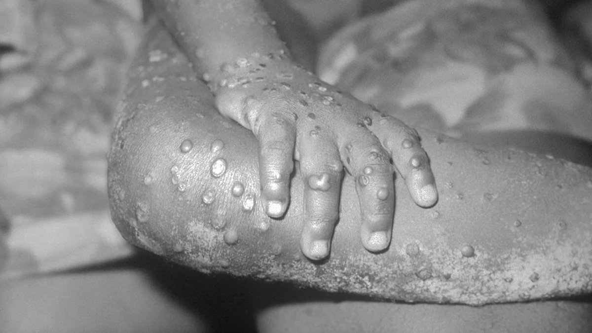 Türkiye'de maymun çiçeği vakası var mı? Sağlık Bakanlığı açıkladı