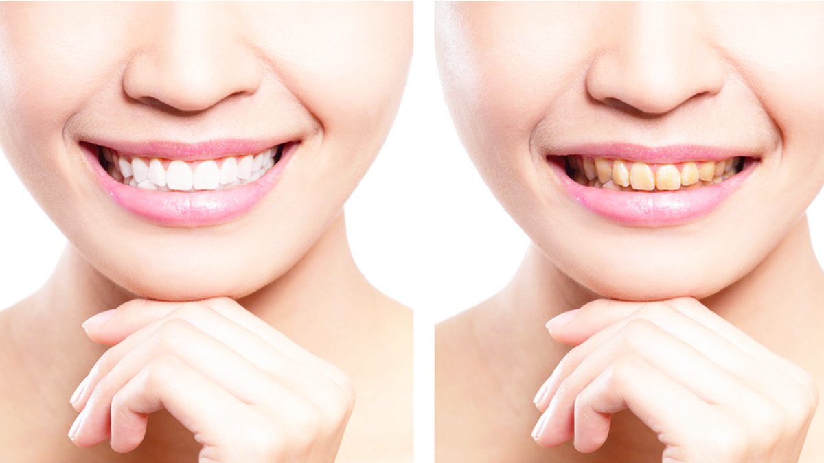 Зубы женщины до и после отбеливания