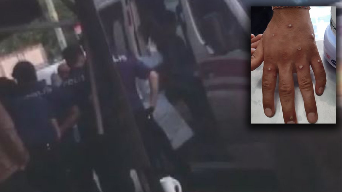 İşte şimdi yandık... İstanbul'da maymun çiçeği alarmı! 'Elleri kabarcık içindeydi'