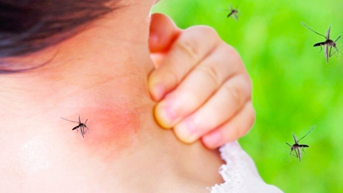 Sivrisineklerin sebep olduğu şişkinlik ve kaşıntıdan kurtulmanın en kolay yolu! İşte mucizevi o doğal yöntem