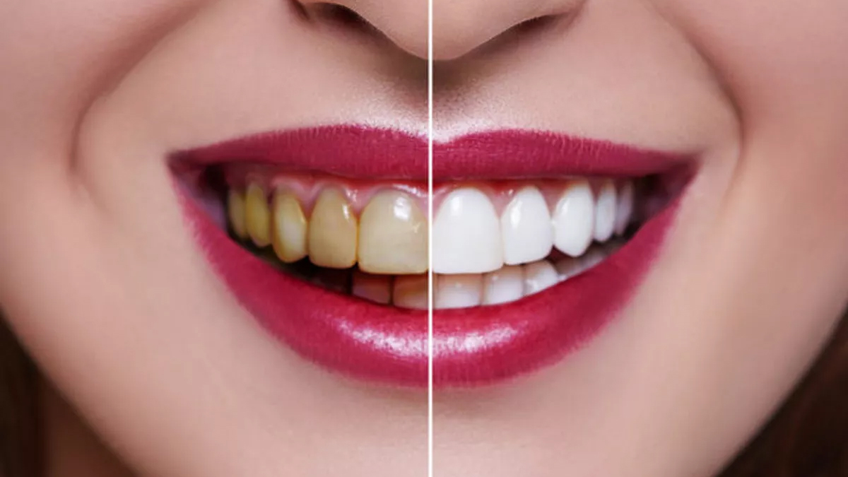 Bu 6 Şeyin Dişleriniz İçin Zarar Verebileceğini Biliyor Muydunuz?