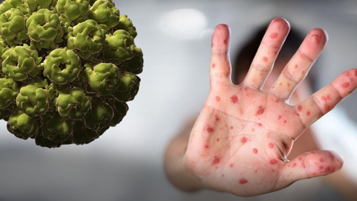 Maymun çiçeği Türkiye'de! Prof. Dr. Levent Doğancı: Çiçek aşısı elde etmemiz lazım