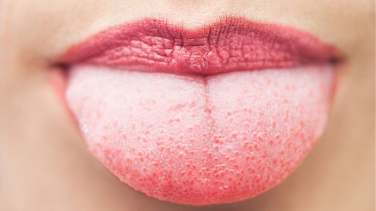 Bu Sebepler Beyaz Dile Sahip Olmanıza Sebep Oluyor