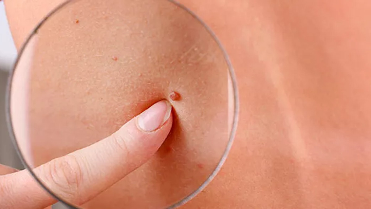 Dermatologlar Vücudunuzdaki Kırmızı Benler İçin Altın Değerinde Bilgiler Veriyorlar