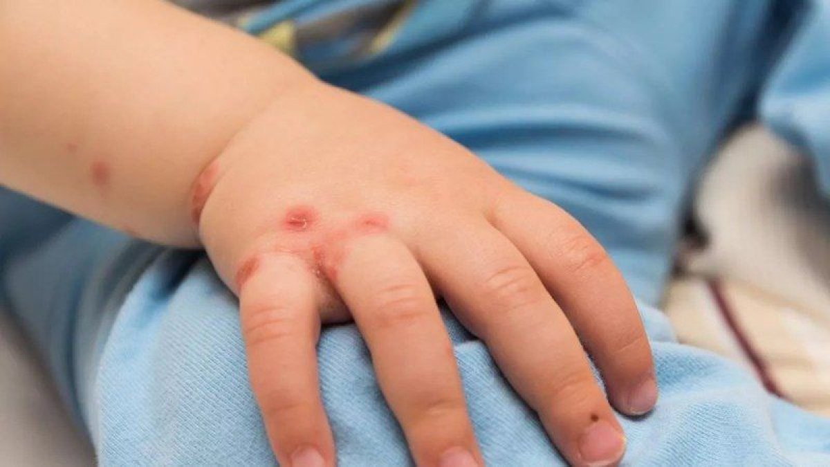 ABD'de çocuklar arasında ilk maymun çiçeği vakası görüldü