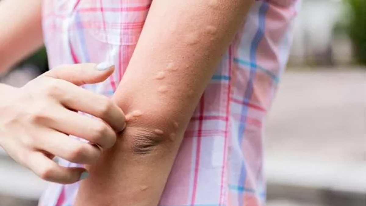 Bu Yöntemleri Öğrenince Sivrisinek Isırıklarına Veda Edeceksiniz