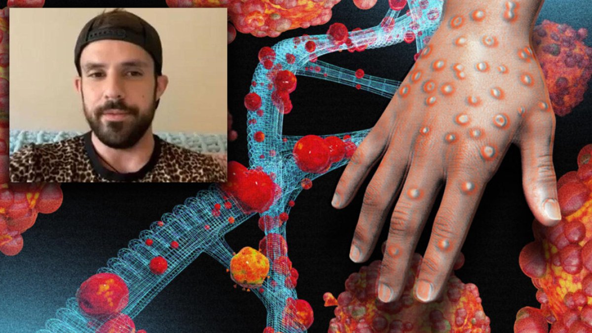 Maymun çiçeği hastası yaşadıklarını anlattı: Acıdan çığlık atıyorum