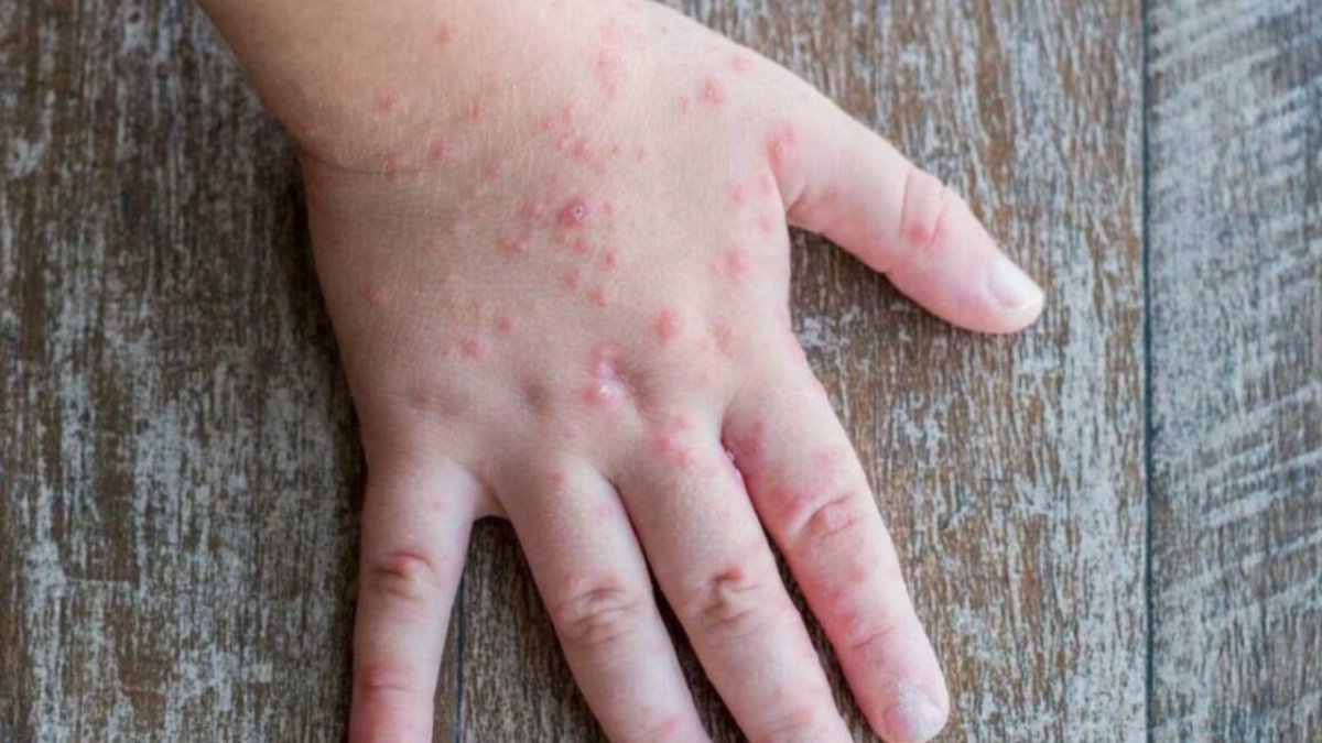 DSÖ, küresel acil durum ilan etmişti: Maymun çiçeği vakası bir ülkede daha görüldü