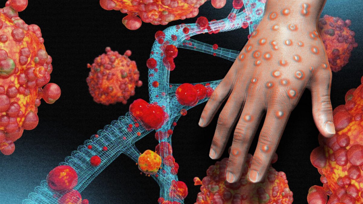 Sağlık Bakanlığı'ndan 'maymun çiçeği' rehberi: Bu belirtiler varsa dikkat!