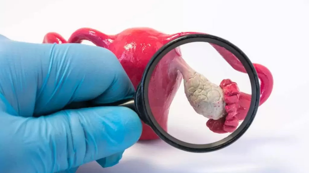 Bu belirtileri yaşıyorsanız yumurtalık kanserine yakalanmış olabilirsiniz! İşte yumurtalık kanserinin belirtileri