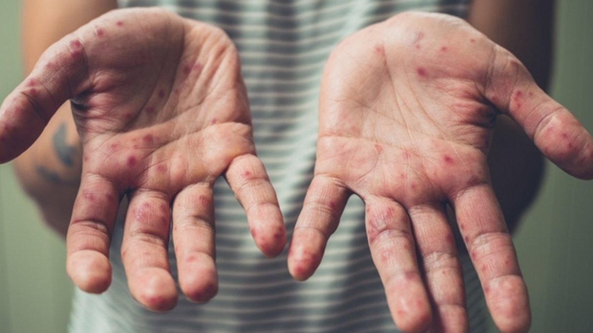 DSÖ 'zaman giderek daralıyor' uyarısında bulunmuştu: Salgın bir ülkede daha görüldü