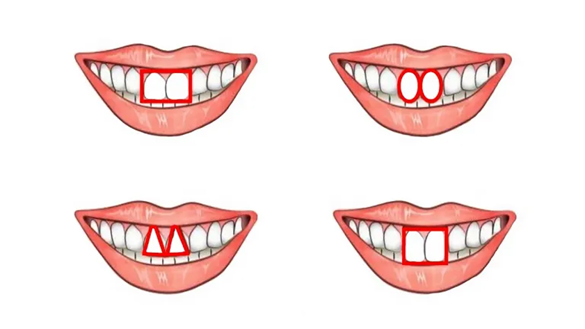 İşte Günün En İlginç Testi: Hipokrat'ın Geliştirdiği Teste Göre Bir İnsanı Ön Dişlerinden Nasıl Tanırsınız?