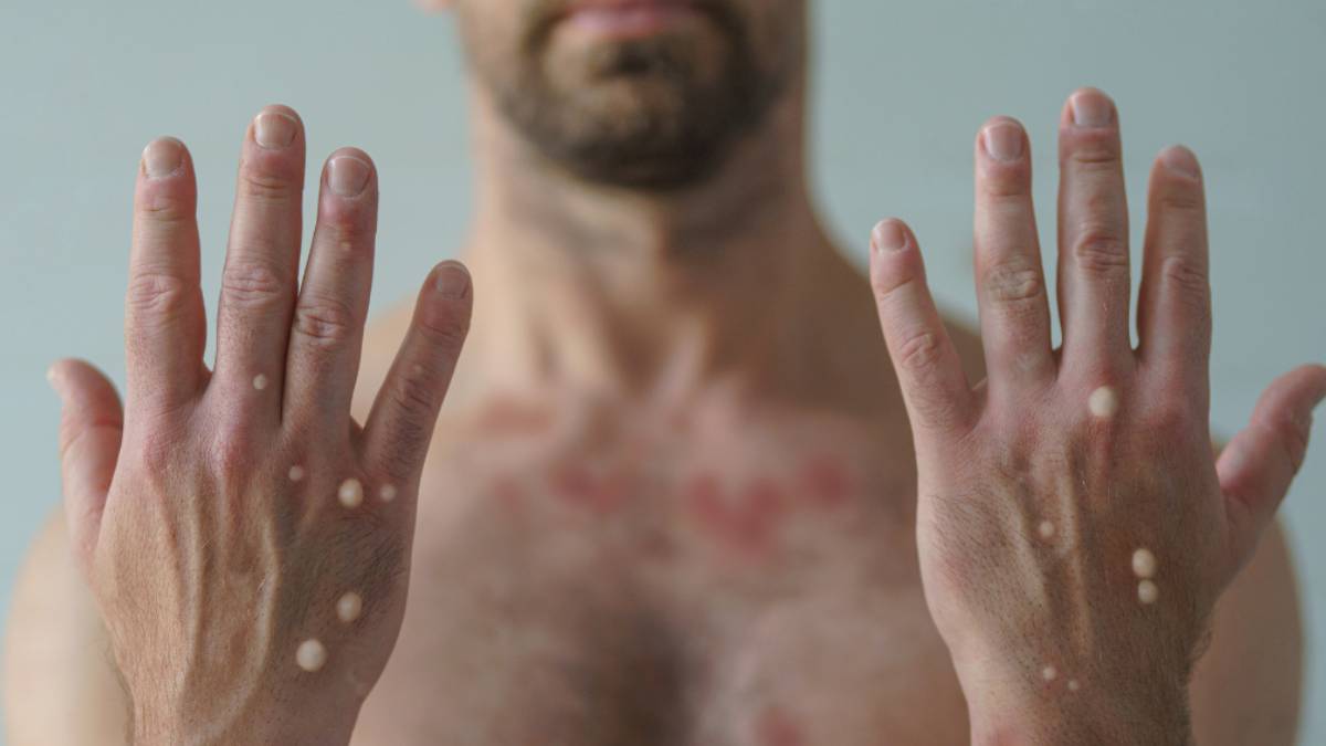 Maymun çiçeğinin hiç bilinmeyen yeni belirtileri! Uzmanlar uyardı, sizde bu rahatsızlıklar varsa...