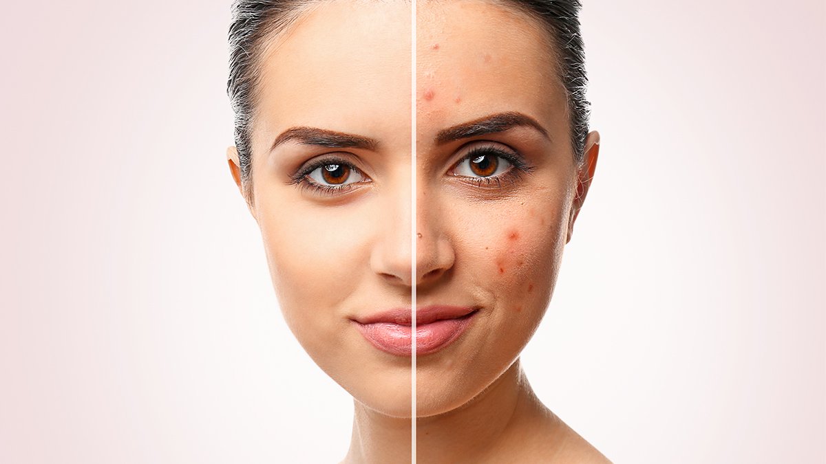 Cilt Lekelerinden Kurtulmanın En İyi Yolu Bu! İşte Cilt Lekeleri Hakkında Bilmeniz Gerekenler
