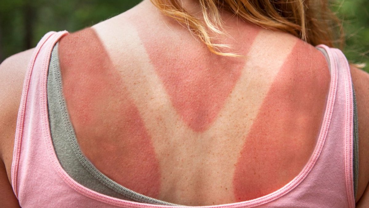 Dermatologlar Önerdi! Anında Rahatlayacaksın... Kullan Ve Bir Gece İçinde Güneş Yanıklarından Kurtul! Her Evde Var...