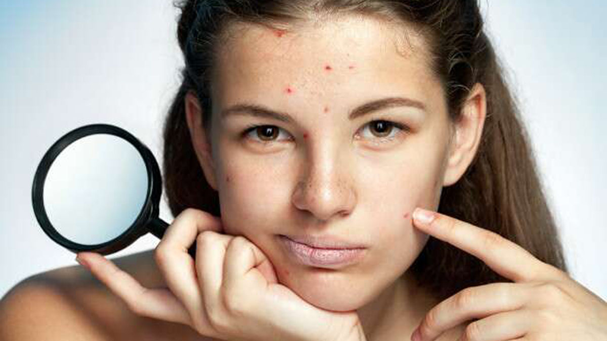 Sivilcelerle ilgili tüm bildiklerinizi unutun! Sivilcelerin asıl oluşum nedenini öğrenince çok şaşıracaksınız