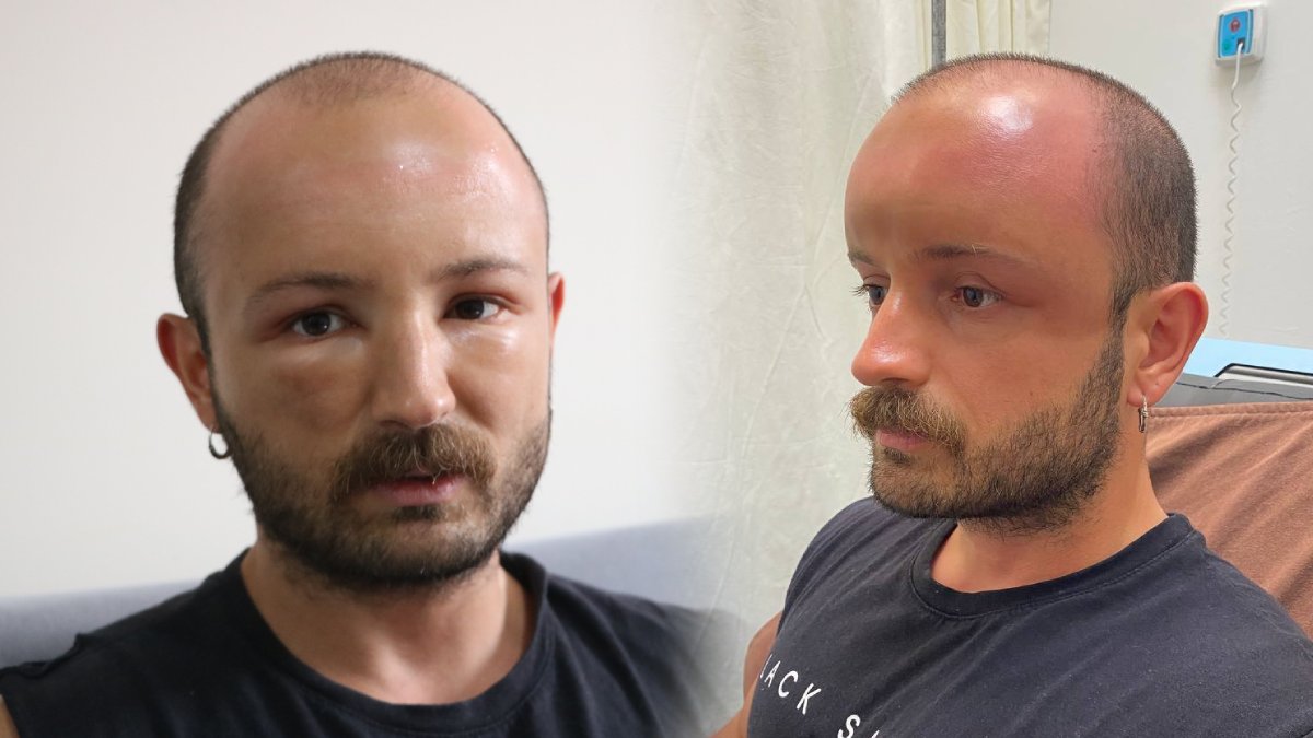 Doktorlar bilimsel çalışma yapacak: İki gün plaja gitti hayatı kabusa döndü