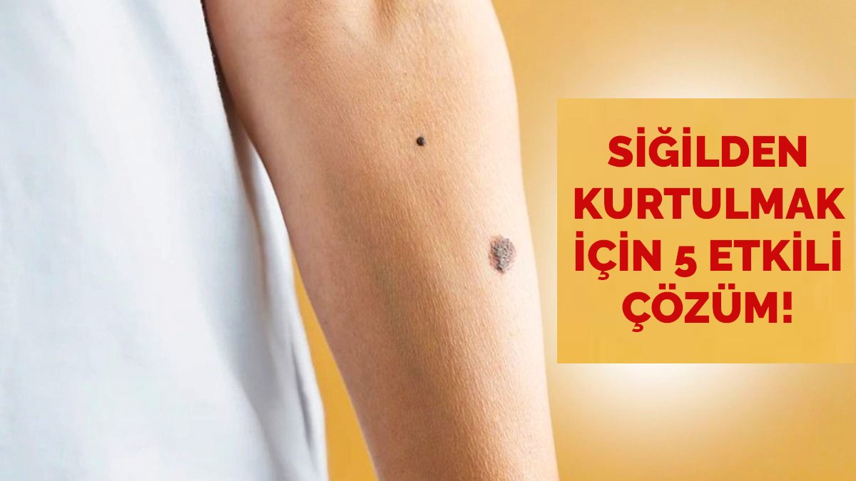 Siğiller kabusunuz olmasın! İşte siğilleri evde tedavi etmek için 5 etkili doğal çözüm