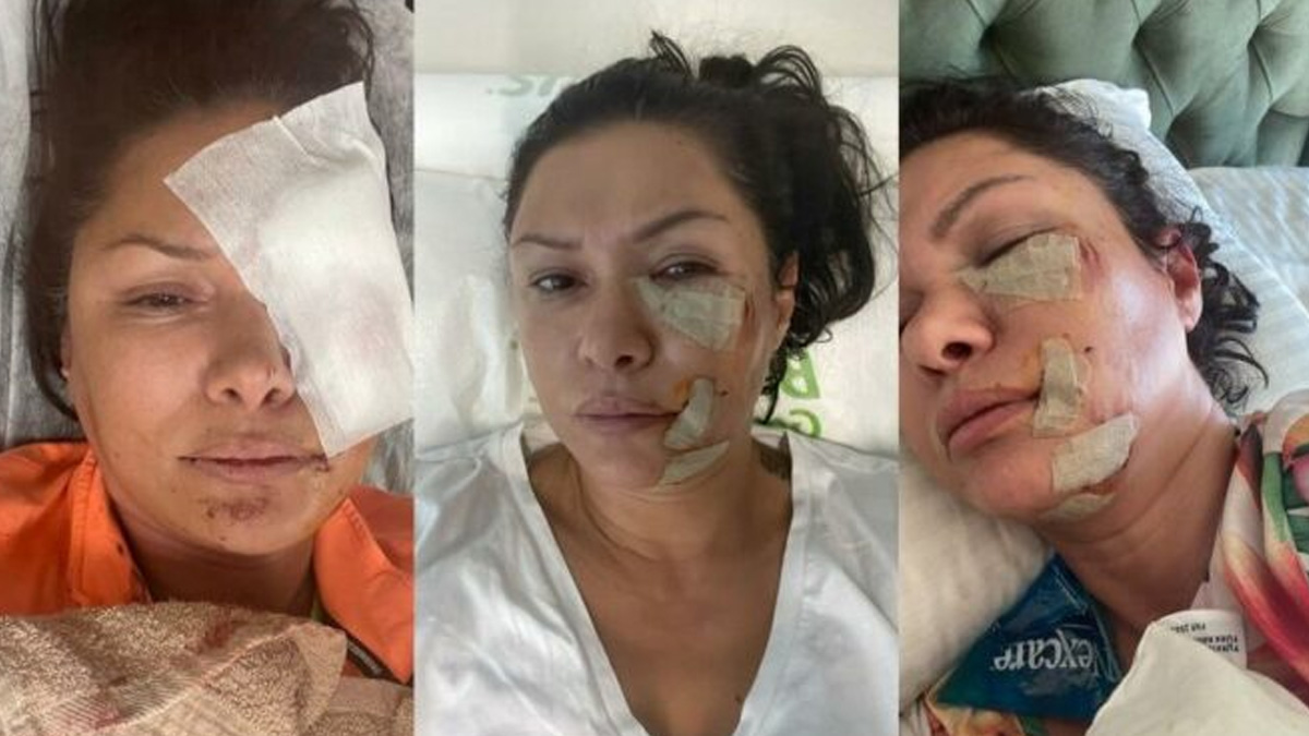 Şile'de köpeğin saldırdığı manken Tuğba Altıntop yüzünden yaralandı