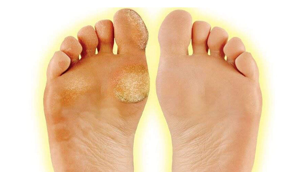 грибок на коже пальцев ног фото