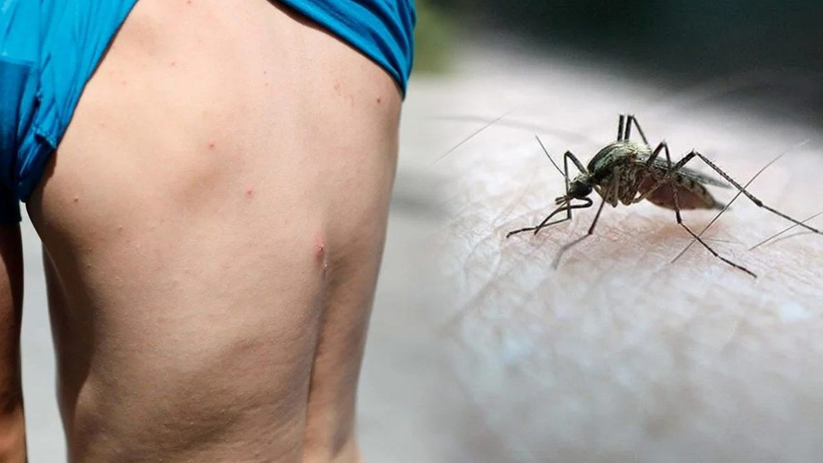 Aedes sivrisineği nedir? Aedes sivrisinek ısırığı nasıl anlaşılır, belirtileri neler? İşte korunma yolları