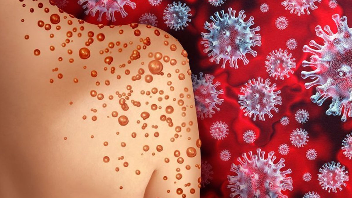 Nijerya'da vaka patlaması: Virüs bulaşan kişi sayısı 318'e çıktı