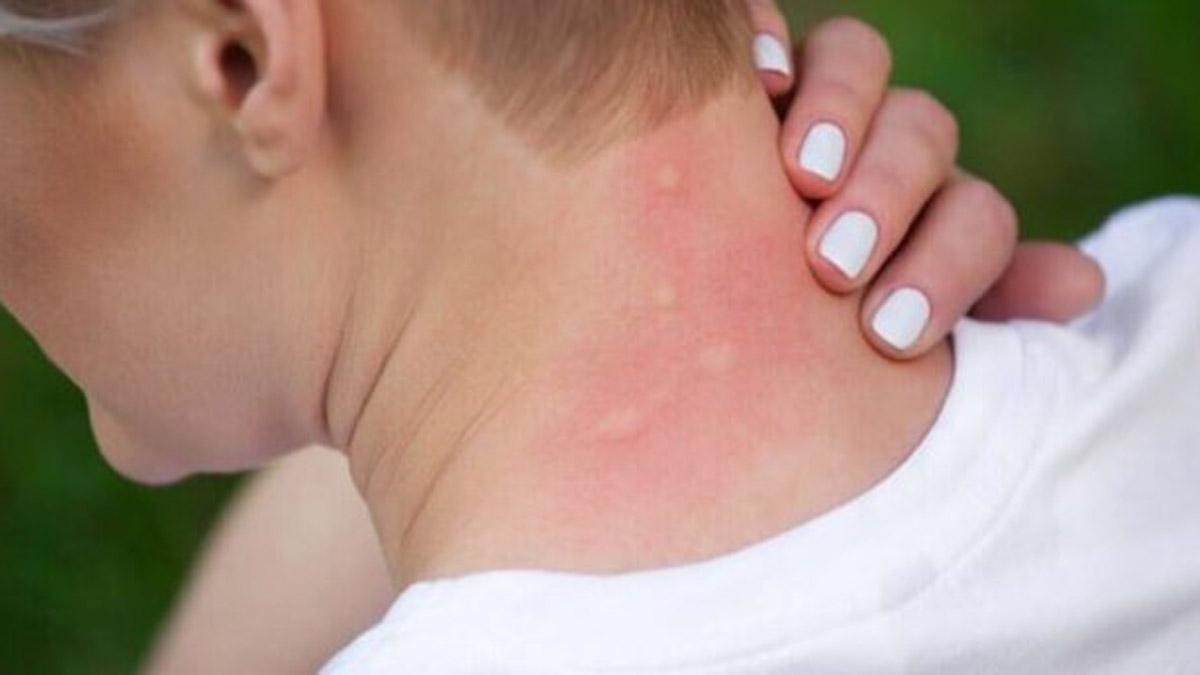 Sadece bu 5 yöntemle geceleri sizi uyutmayan o sinek ısırıklarına veda edebilirsiniz