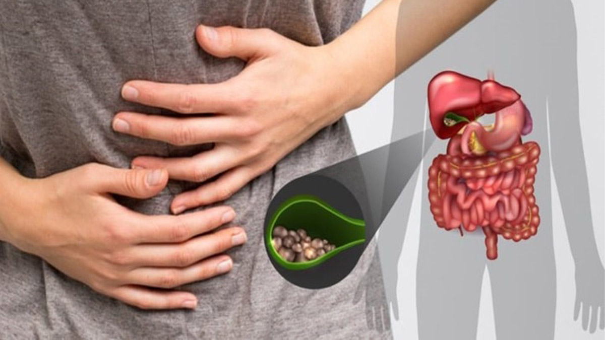 Safra kesesi problemi olanlar dikkat! İşte yemeniz gereken gıdalar ve uzak durmanız gereken gıdalar